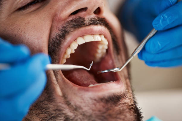 Best Emergency Tooth Extraction in Sherwood, OH